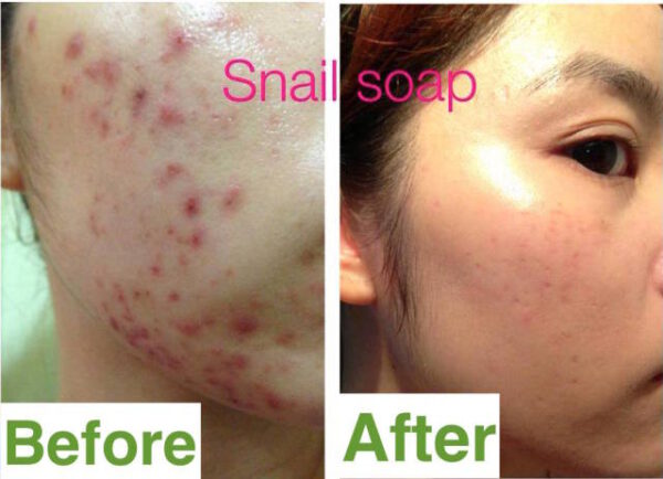 SNAIL SOAP Retinol Arbutin + White Natural Cocoons : Acne Whitening Brightening - Image 3