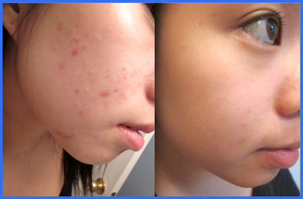 Hiruscar PostAcne Gel reduce & treatment acne scar dark spot red mark pimple 5 g. - Image 4
