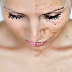 Cosmetic : The Best of Anti Melasma & Freckles Cream : 7 g. : Intense Formula