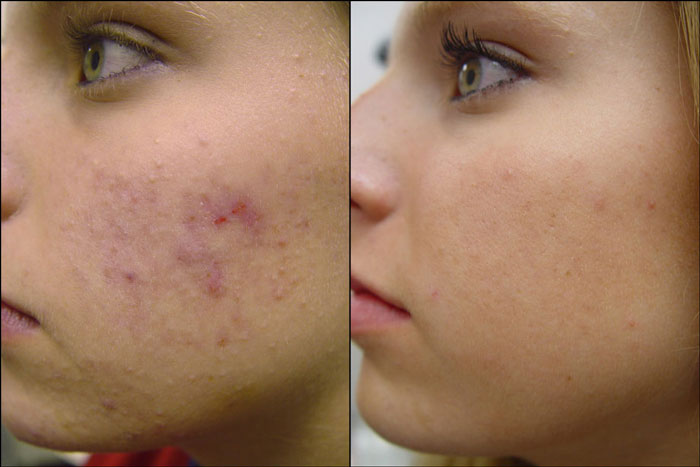 How to use Tretinoin cream to treat wrinkles?