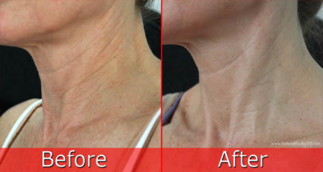 Original Retin-A (Tretinoin) / Retinol-A Cream Serum & Gel. The legendary anti-aging wrinkle acne cream and gel.