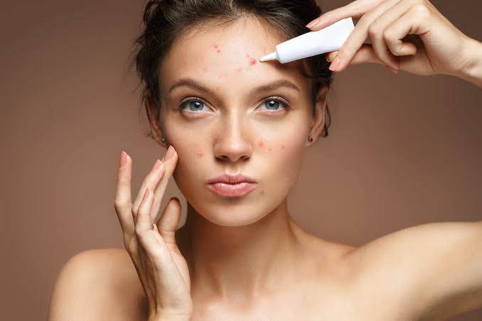 Tips for Caring for Acne-Prone Skin
