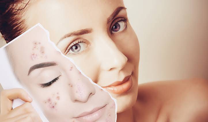 Say Goodbye to Wrinkles and Stubborn Acne with Tretinoin!