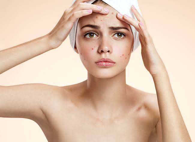 Dealing with Oily Skin and Acne: What to Use for Clear and Balanced Skin
