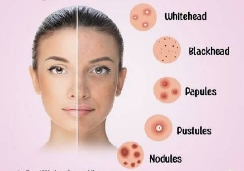 Types of acne, Causes, and Effective Treatments