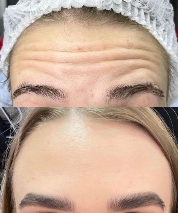 Cosmetic : Original Vit-A Soft Gel Set : 10 g. X 2 Tubes : Intense Formula - Acne Aging by T.Man - Image 5