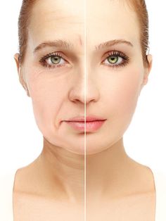 How to get rid of your smile lines