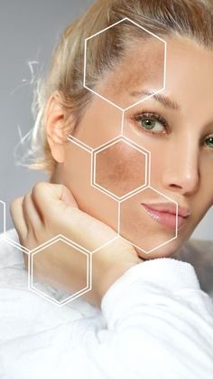 How to Care for Skin with Freckles and Melasma
