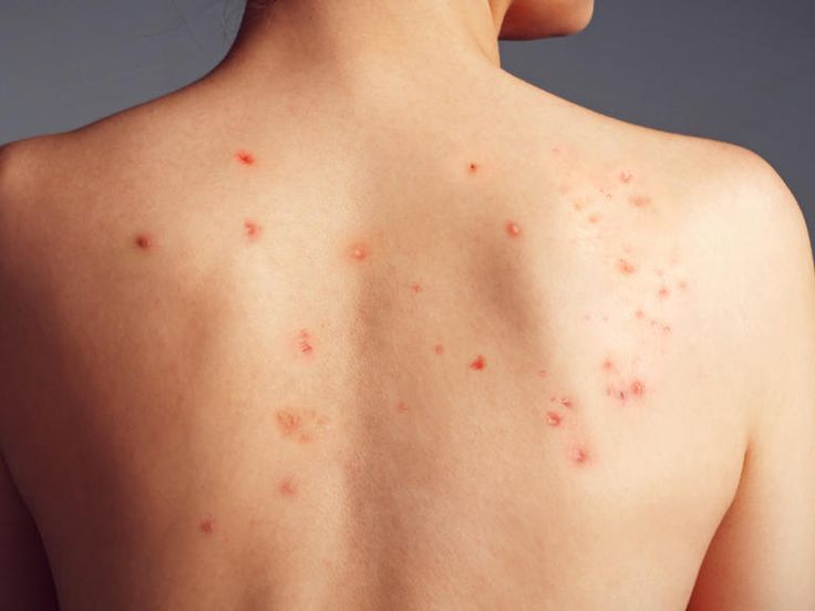 Back acne : Cuases and How to Treat It