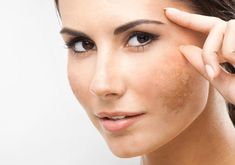 What’s the Best Treatment for Melasma?